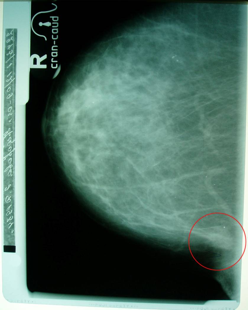 Маммография молочных желез 4. Склерозирующий аденоз рентген. Аденоз молочной железы рентген. Мелкоузелковый аденоз. Склерозирующий аденоз молочной рентген.